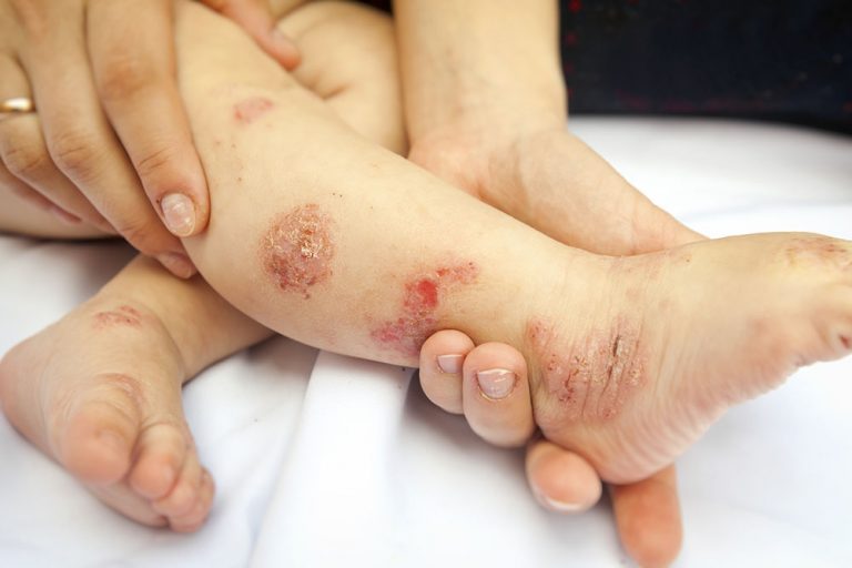 Hand Fuß Mund Krankheit Wichtige Infos Zur Kinderkrankheit
